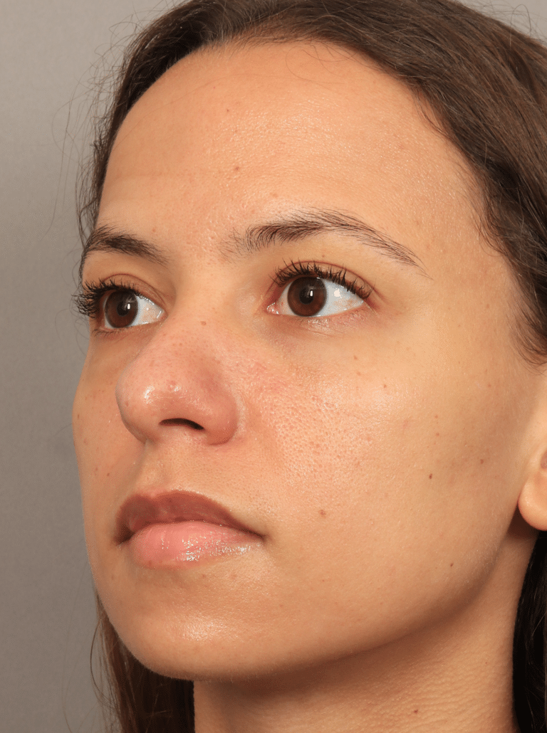 After Image: Lower Blepharoplasty (3.5 Months Post-op) - left-front-oblique