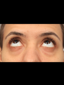 Before Image: Lower Blepharoplasty (3.5 Months Post-op)