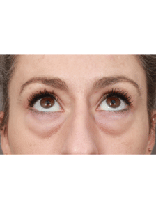 Before Image: Upper/Lower Blepharoplasty (Eyelid Lift), Brow Lift, Deep Plane Facelift and Neck Lift, Buccal Fat Removal, Fat Grafting, and CO2 Laser Resurfacing (1 Year Post-op)