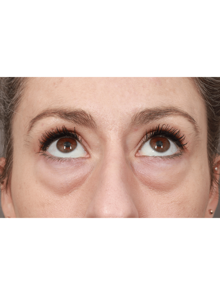 Before Image: Upper/Lower Blepharoplasty (Eyelid Lift), Brow Lift, Deep Plane Facelift and Neck Lift, Buccal Fat Removal, Fat Grafting, and CO2 Laser Resurfacing (1 Year Post-op) - front