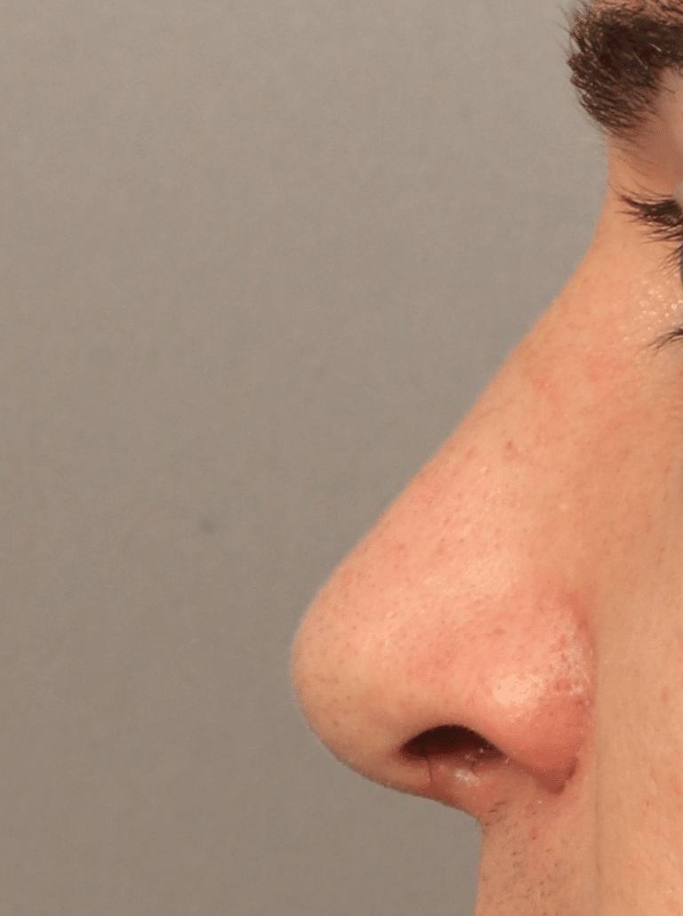 After Image: Rhinoplasty, Septoplasty, and Alarplasty (4.5 Months Post-op) -