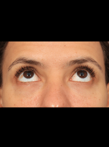 After Image: Lower Blepharoplasty (3.5 Months Post-op)