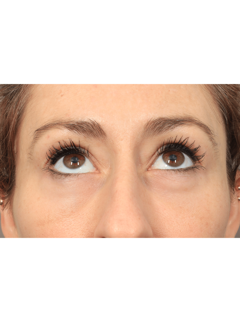 After Image: Upper/Lower Blepharoplasty (Eyelid Lift), Brow Lift, Deep Plane Facelift and Neck Lift, Buccal Fat Removal, Fat Grafting, and CO2 Laser Resurfacing (1 Year Post-op) - front