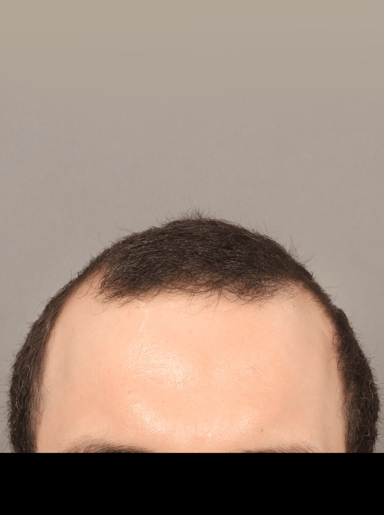 Before Image: NeoGraft Hair Transplant - front