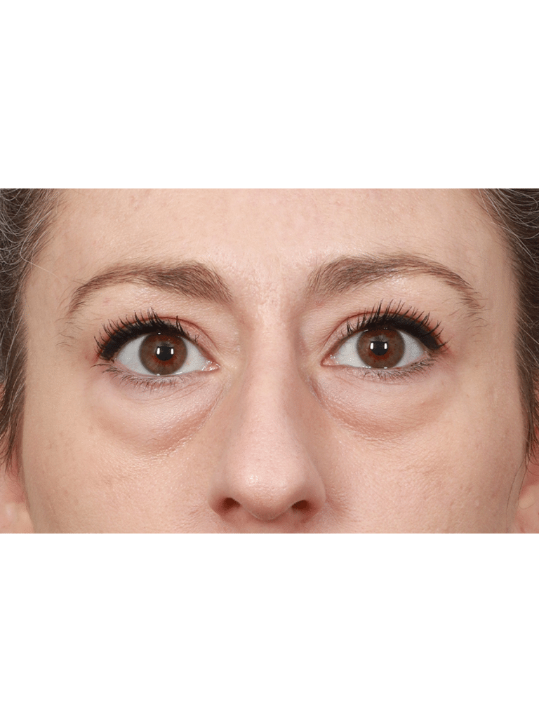 Before Image: Upper/Lower Blepharoplasty (Eyelid Lift), Brow Lift, Deep Plane Facelift and Neck Lift, Buccal Fat Removal, Fat Grafting, and CO2 Laser Resurfacing (1 Year Post-op) - front