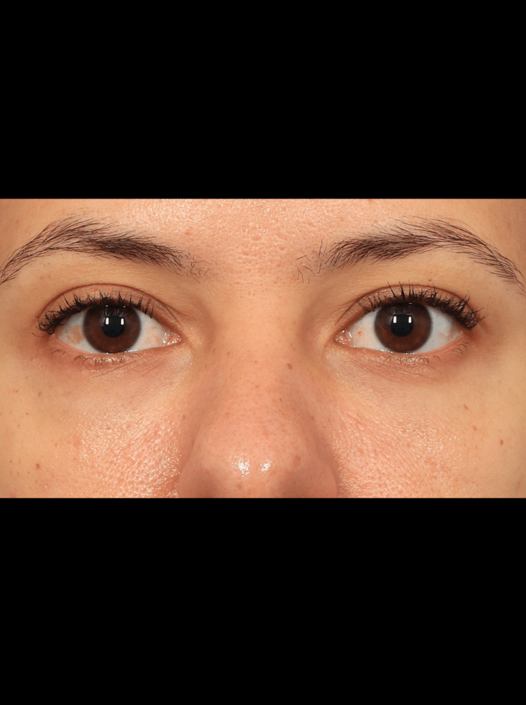 After Image: Lower Blepharoplasty (3.5 Months Post-op) -