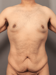 Before Image: Circumferential Toroplasty with Liposuction & Renuvion Skin Tightening (1 Year Post-op)