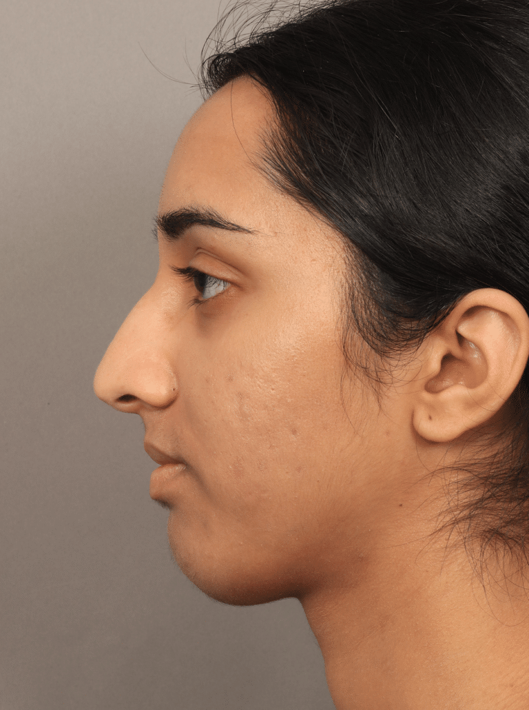 Before Image: Rhinoplasty with an Alarplasty (4 Months Post-op) - front