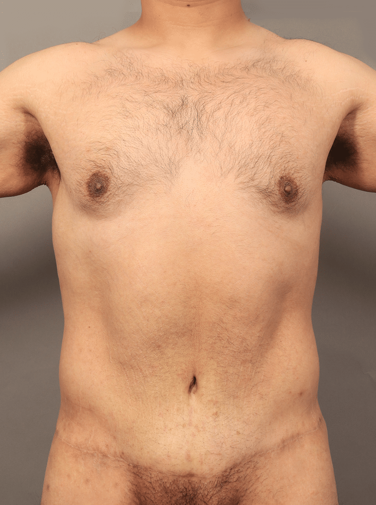 After Image: Circumferential Toroplasty with Liposuction & Renuvion Skin Tightening (1 Year Post-op) - front