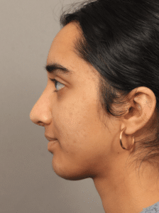 After Image: Rhinoplasty with an Alarplasty (4 Months Post-op)