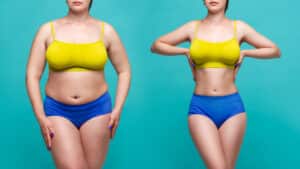 Before and after shots of a woman’s stomach after she’s had a tummy tuck and her stomach has slimmed