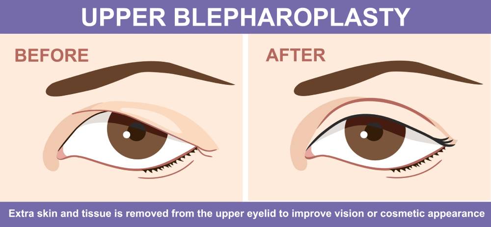 Diagram shows upper eyelid surgery before and after to address sagging skin above the eye that ages the face.