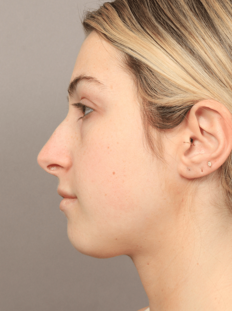 Before Image: Rhinoplasty (9 Months Post-op) - left-side