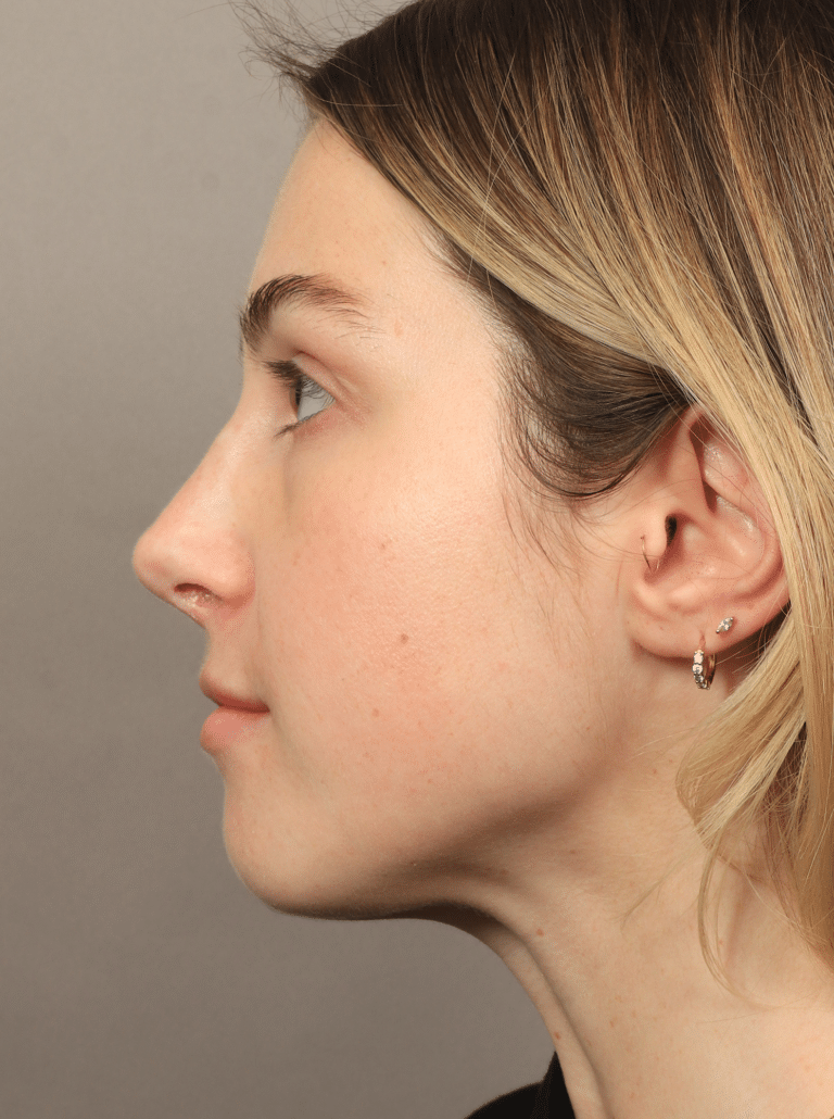 After Image: Rhinoplasty (9 Months Post-op) - left-side