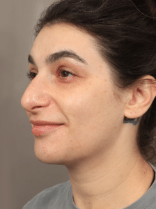 Before Image: Cheek, Chin, & Midface Filler