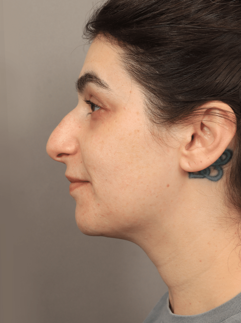 Before Image: Cheek, Chin, & Midface Filler - left-side