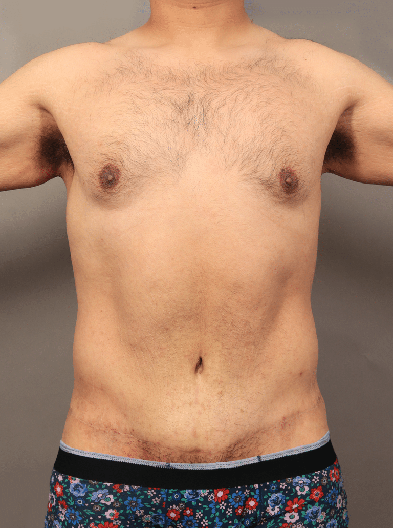 After Image: Post Massive Weight Loss: Circumferential Toroplasty with Liposuction & Renuvion Skin Tightening (1 Year Post-op) - front