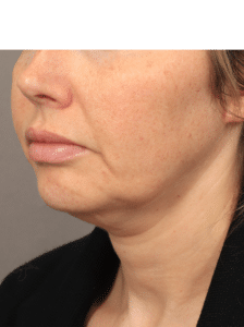 Before Image: Deep Plane Facelift and Neck Lift with Buccal Fat Removal (6.5 Months Post-op)