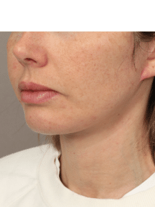 After Image: Deep Plane Facelift and Neck Lift with Buccal Fat Removal (6.5 Months Post-op)