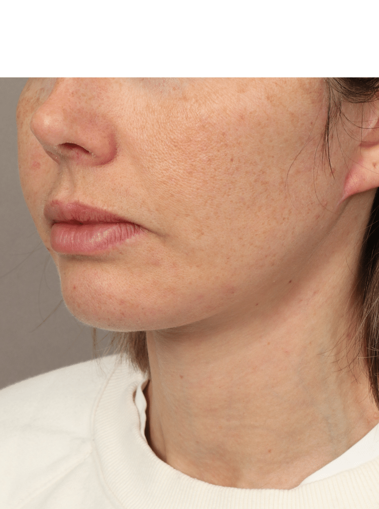 After Image: Deep Plane Facelift and Neck Lift with Buccal Fat Removal (6.5 Months Post-op) - left-front-oblique