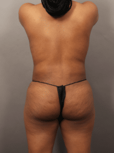 After Image: VASER Liposuction with Fat Transfer to Hip Dips (1.5 Months Post-op)