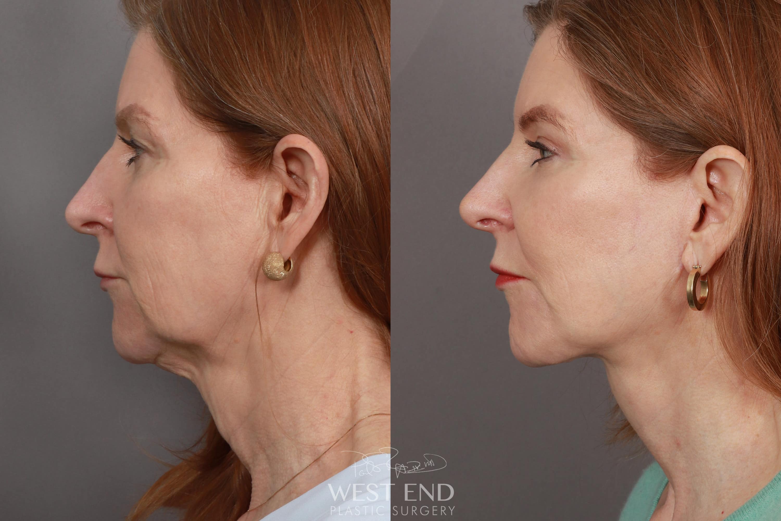 Face Procedures Before And After Gallery West End Plastic Surgery 4980