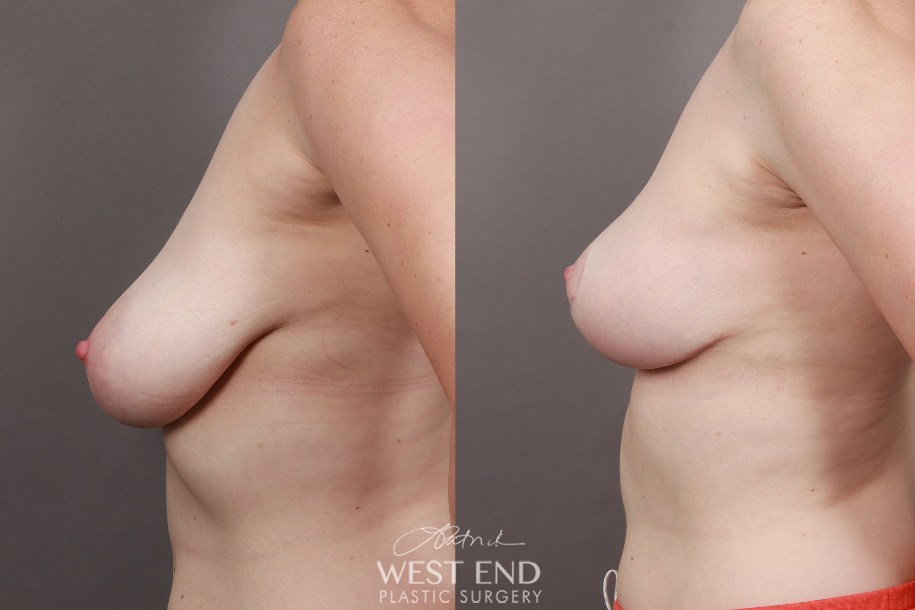 Breast Lift Months Post Op Before After Gallery Case