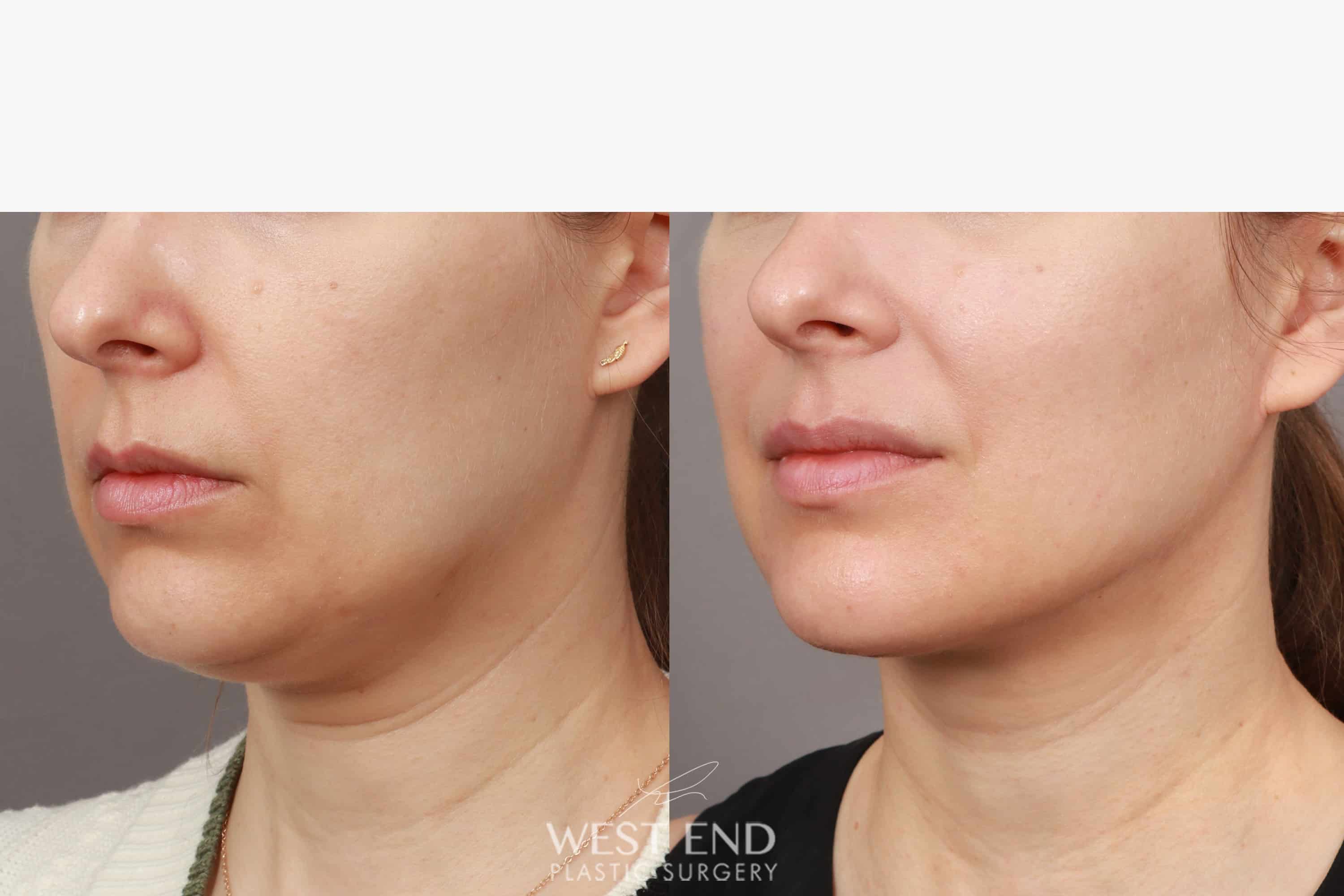 Liposuction Renuvion Skin Tightening Month Post Op Before After Gallery Case