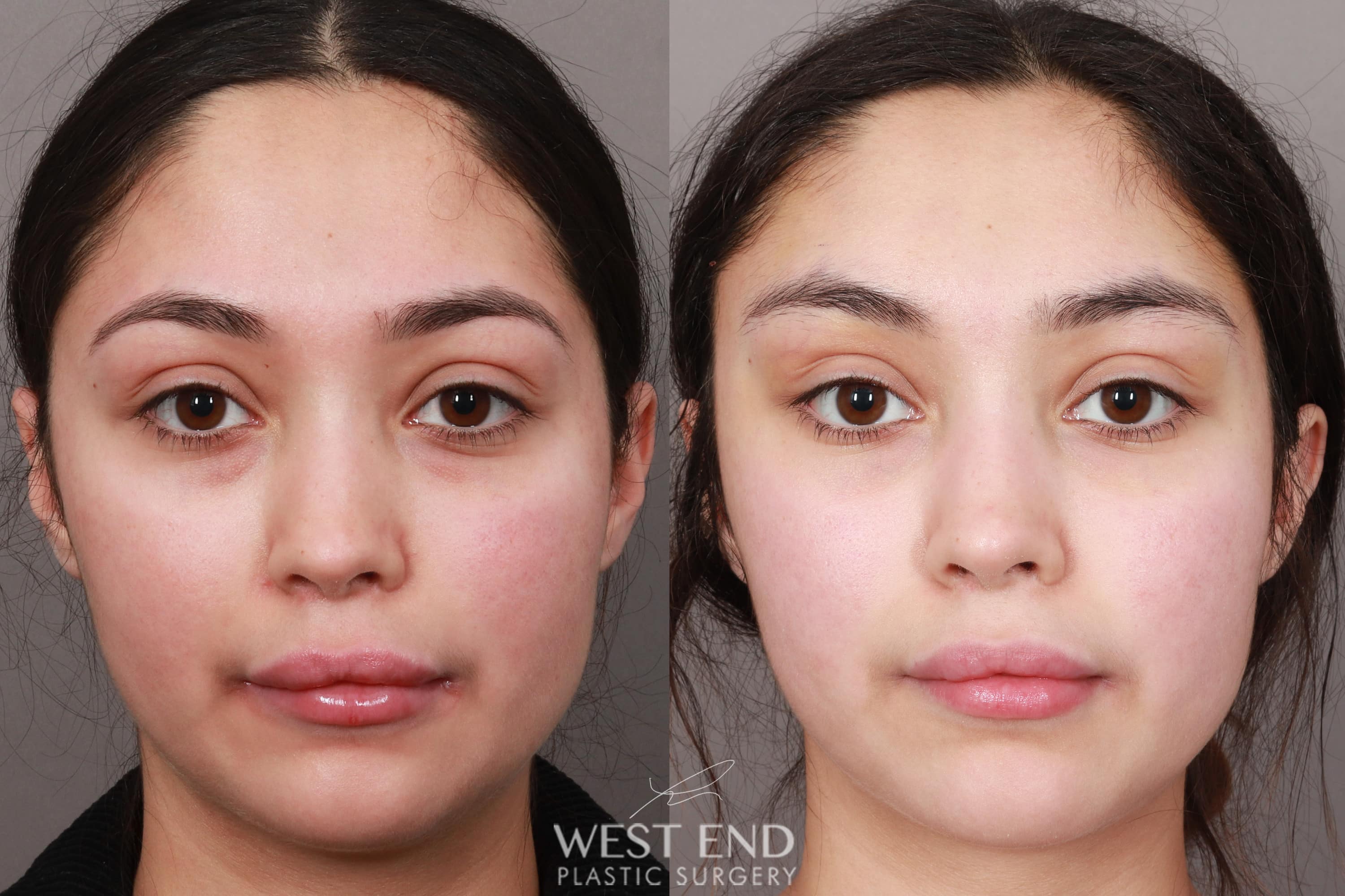 Temporal Brow Lift 1 Week Post Op Case 10635 West End Plastic Surgery 