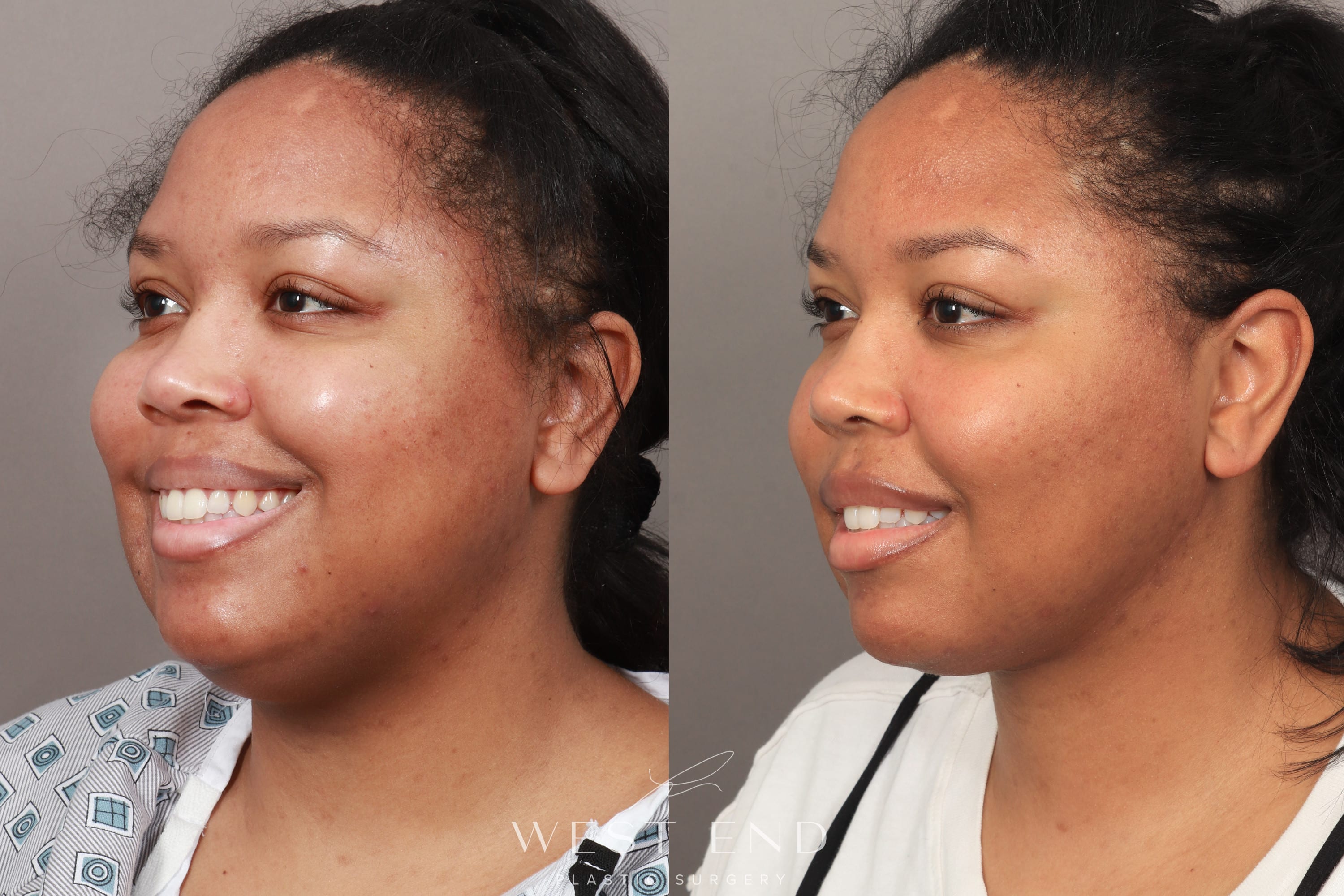 Buccal Fat Removal Liposuction And Renuvion Skin Tightening 1 Month Post Op Before And After 2692