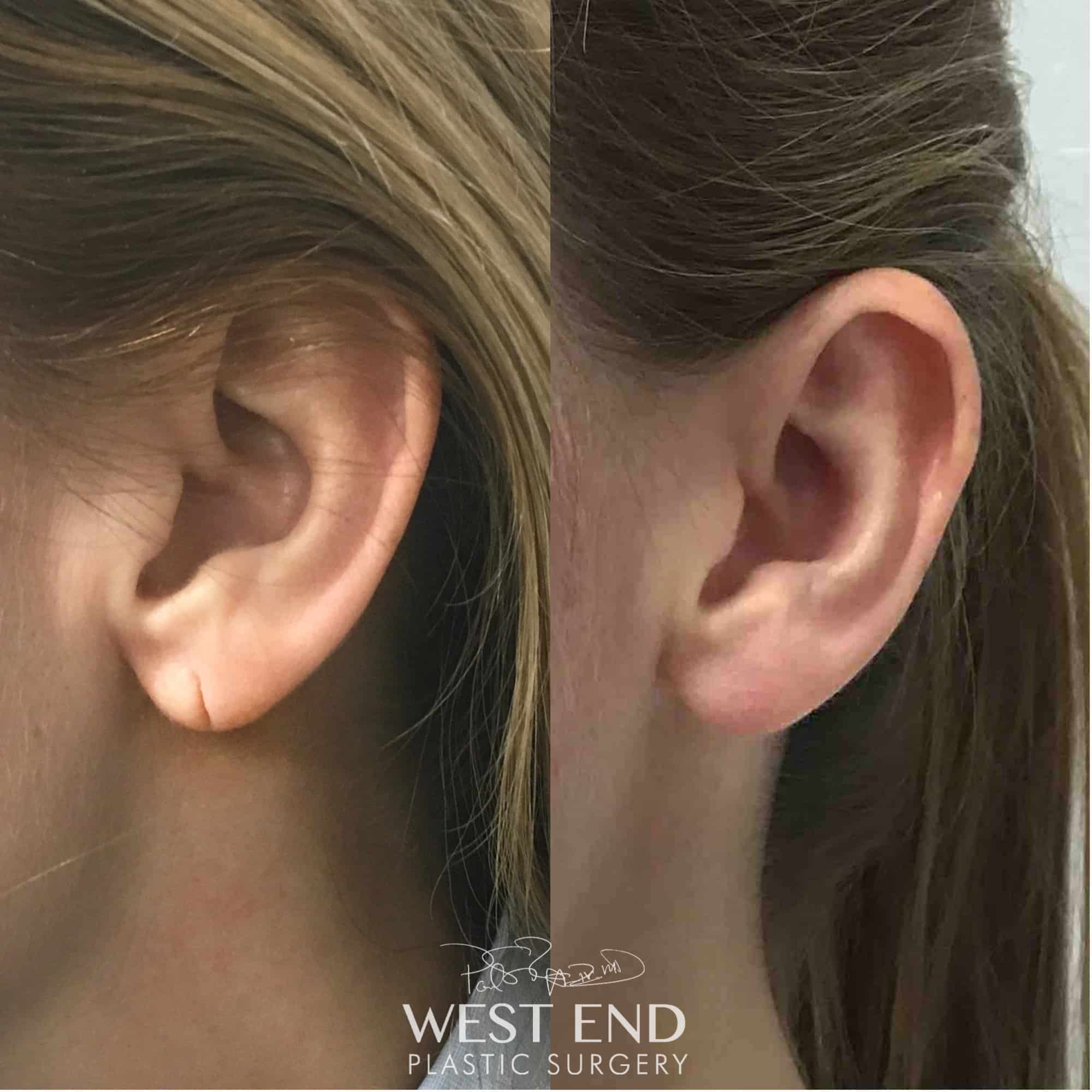 Earlobe Repair Before and After Gallery
